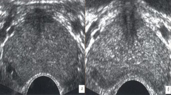 Ultraschall vor und nach der Behandlung mit Prostovit-Tropfen.